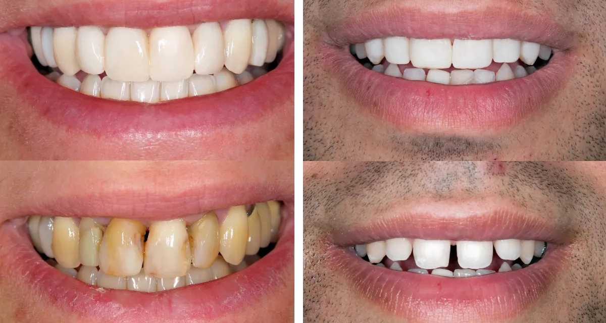Smile Design -  Dental Veneers